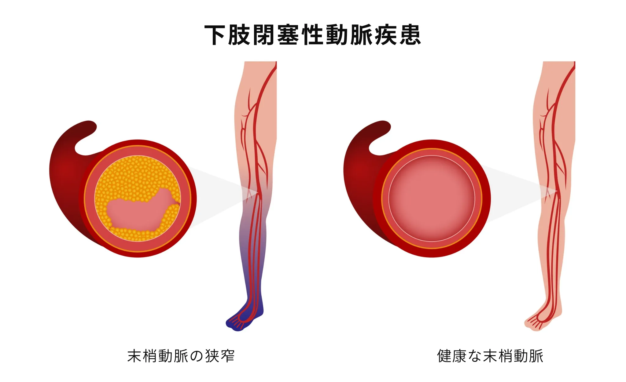 下肢閉塞性動脈疾患（LEAD）