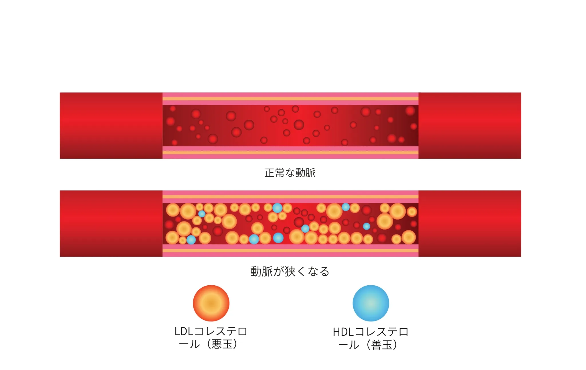 脂質異常症とは