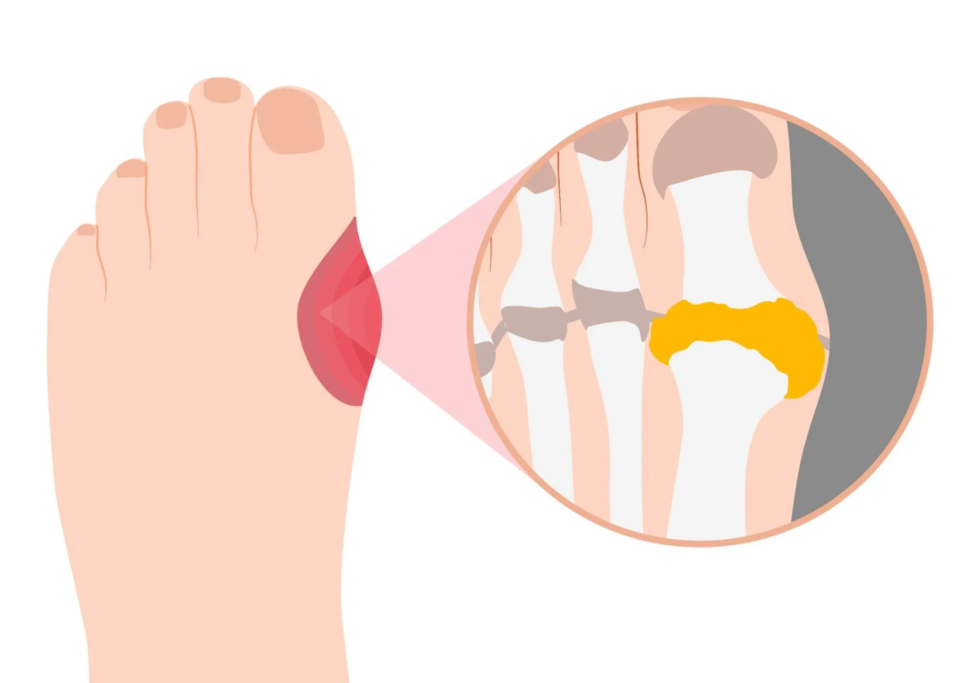 高尿酸血症・痛風とは