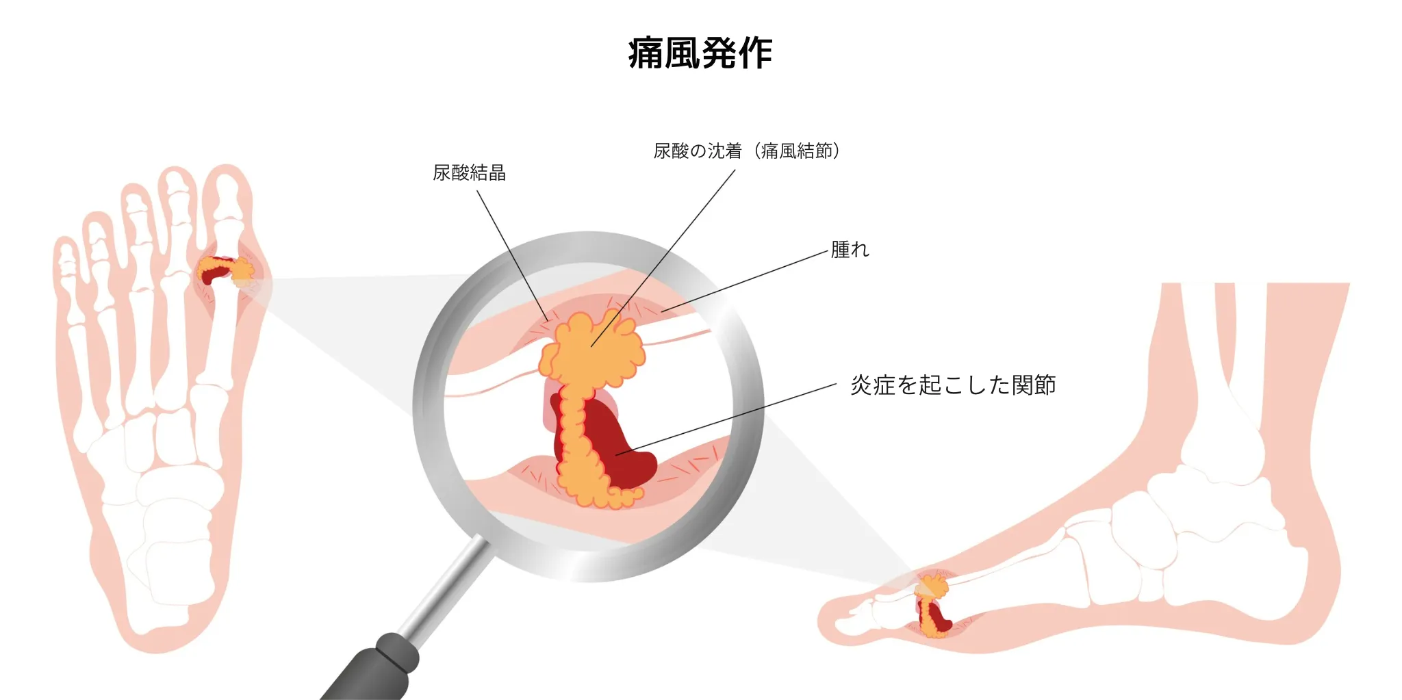 高尿酸血症が引き起こす合併症