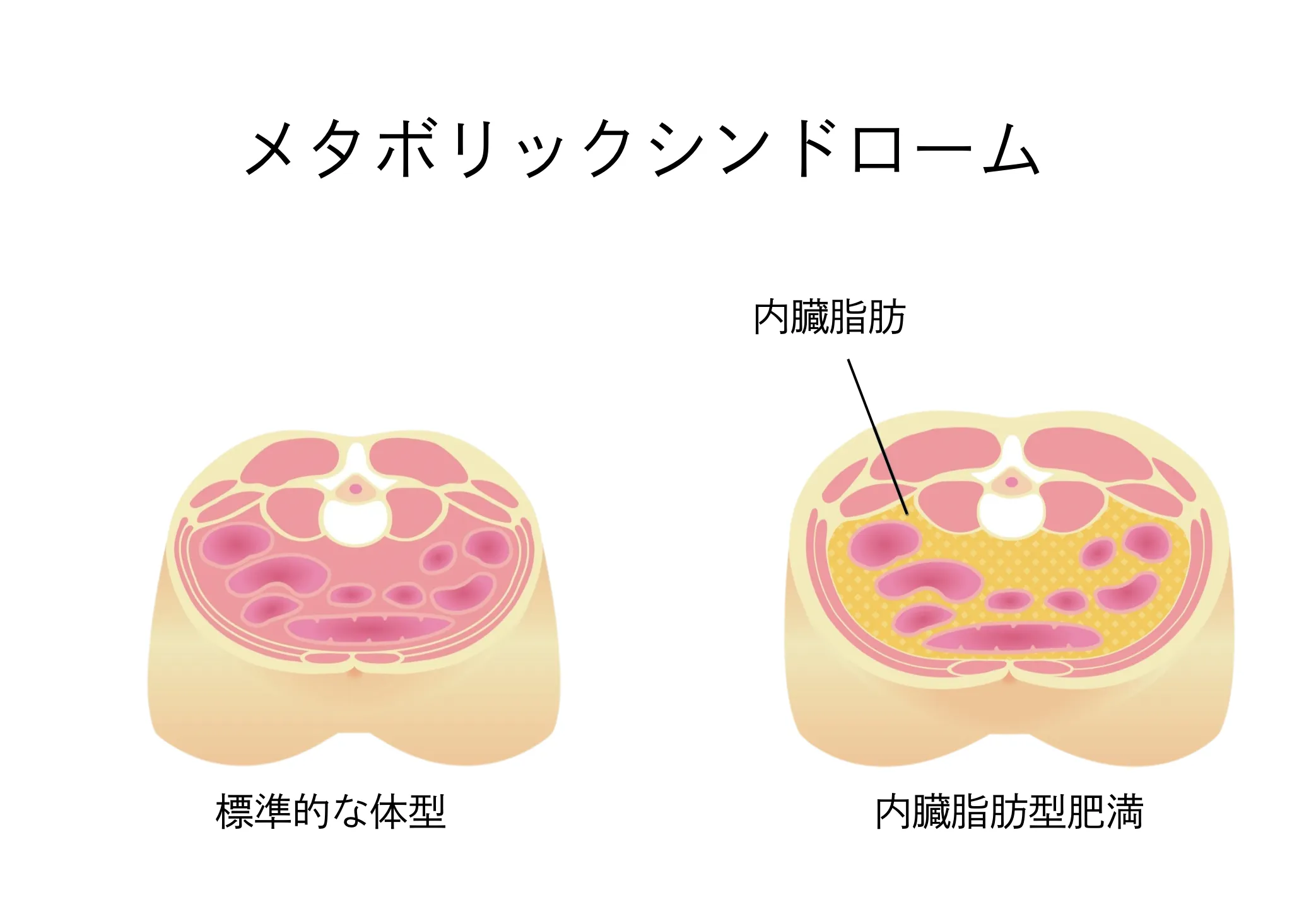 メタボリックシンドロームとは